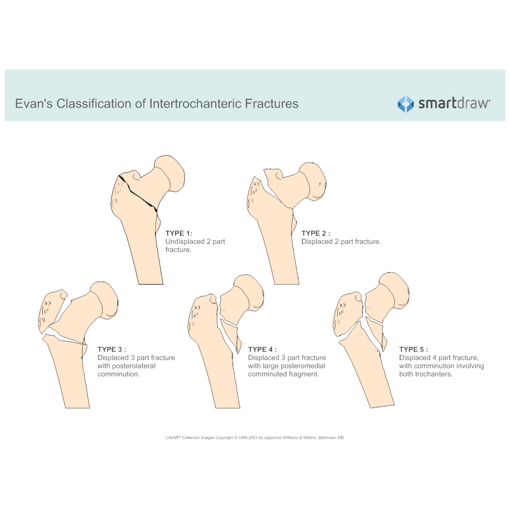 icd 10 code for left intertrochanteric fracture