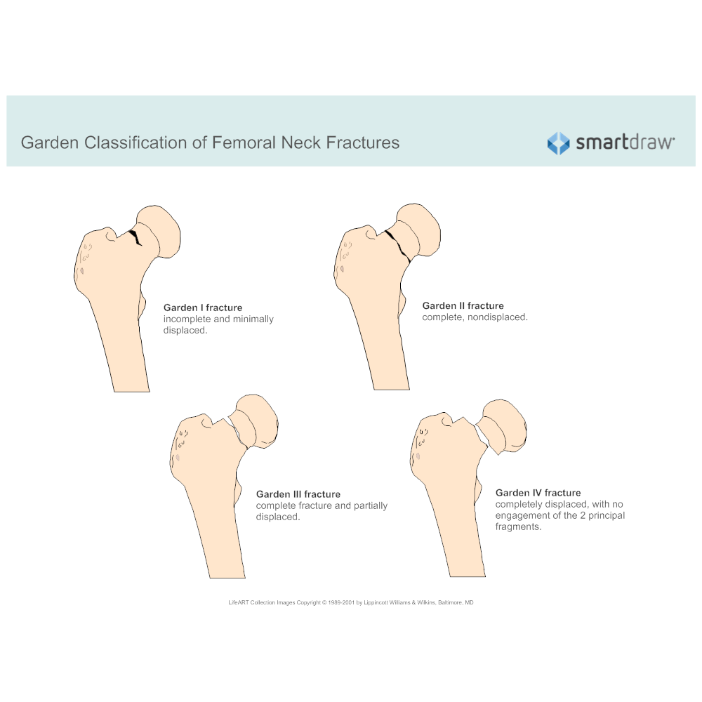 Garden Classification of Femoral Neck Fractures