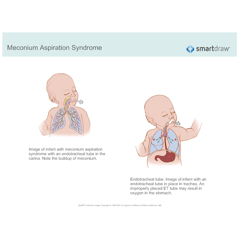 Meconium Aspiration Syndrome Pathophysiology Clinical - vrogue.co