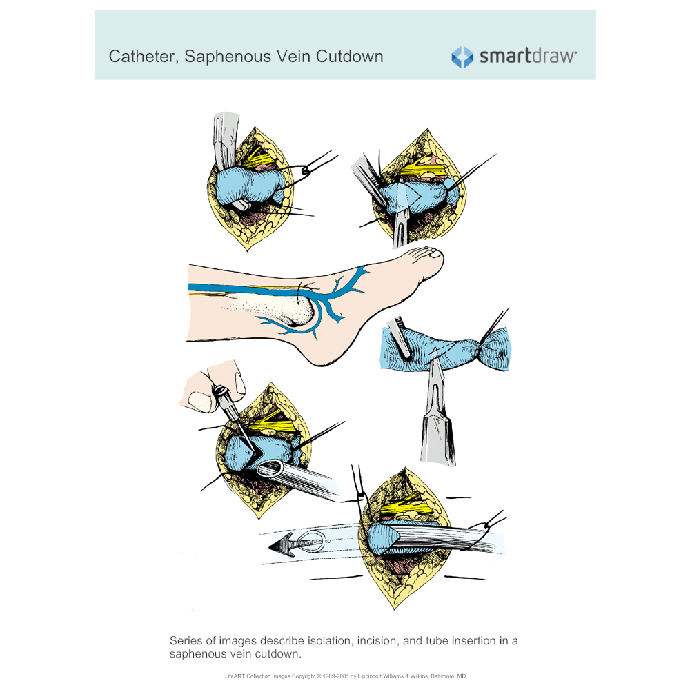 Catheter - Saphenous Vein Cutdown